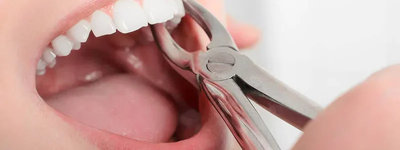 Tooth-Extraction