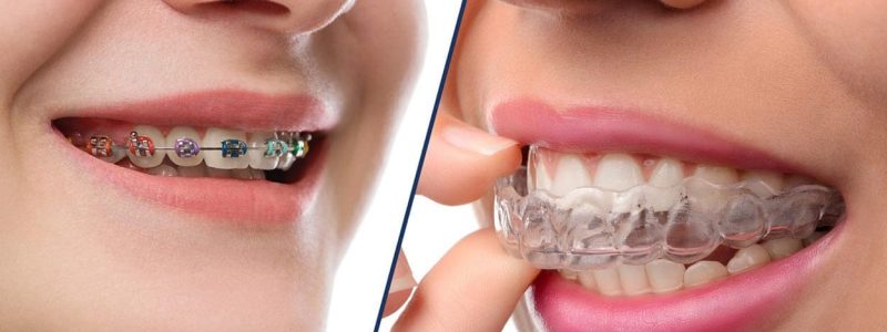 invisalign-or-braces (1)